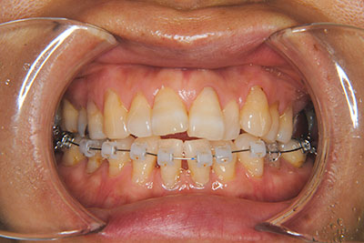 治療例1　上顎前突と叢生