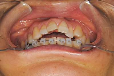 治療例1　上顎前突と叢生