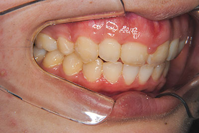 治療例3　出っ歯