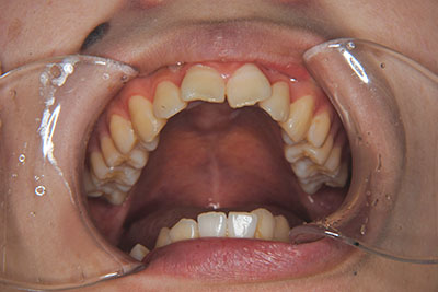 治療例3　出っ歯