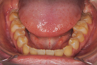 治療例4　開咬と前突（出っ歯）