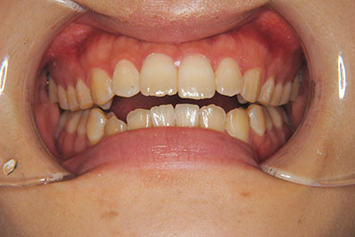 治療例4　開咬と前突（出っ歯）