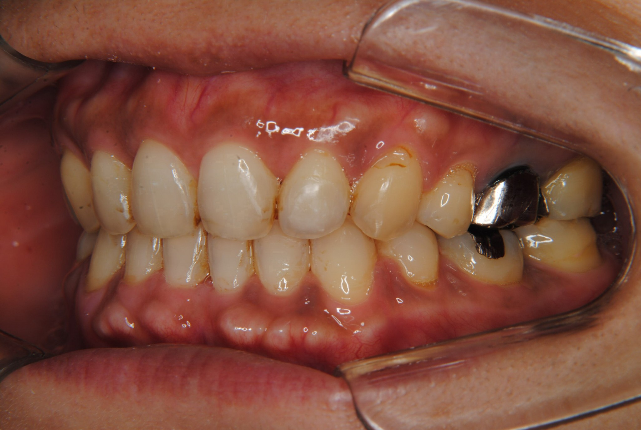 上下前歯の突出を抜歯により治療した40代女性
