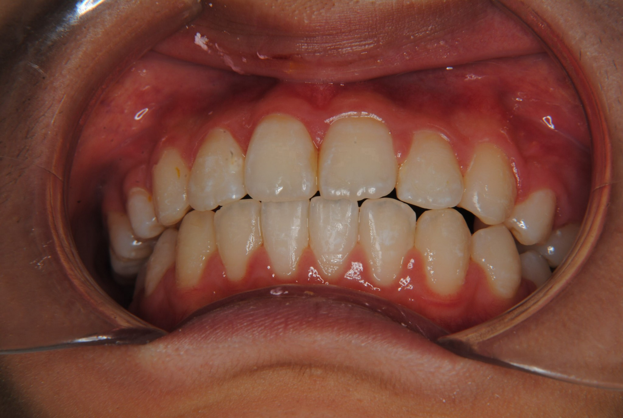 上の永久歯2本を抜いて出っ歯を治した中学生女子
