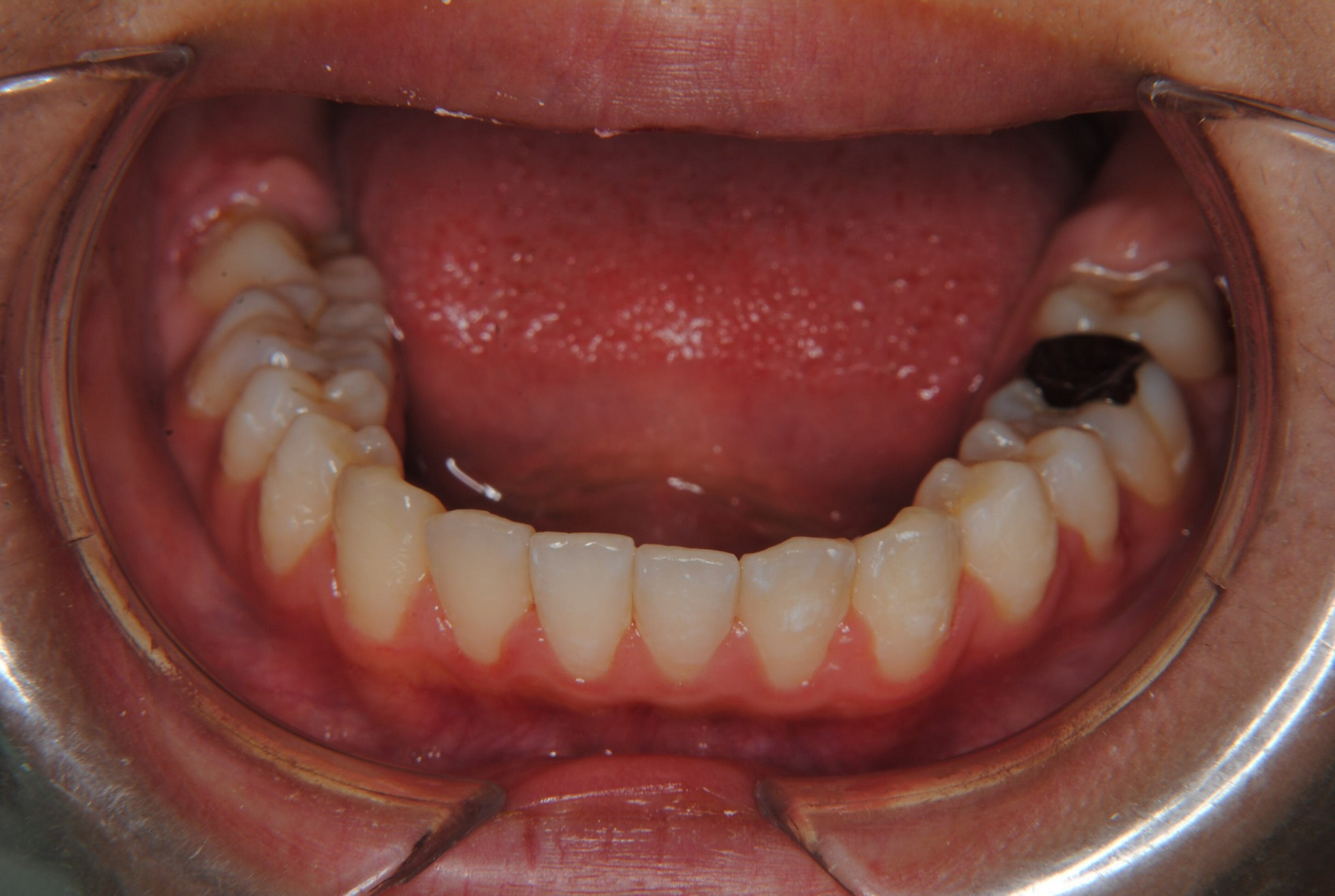 上の永久歯2本を抜いて出っ歯を治した中学生女子