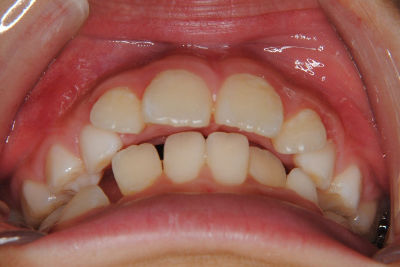 8歳の男子、下左右5番目の乳歯の下の永久歯がなく、上の小臼歯抜歯で治りました。