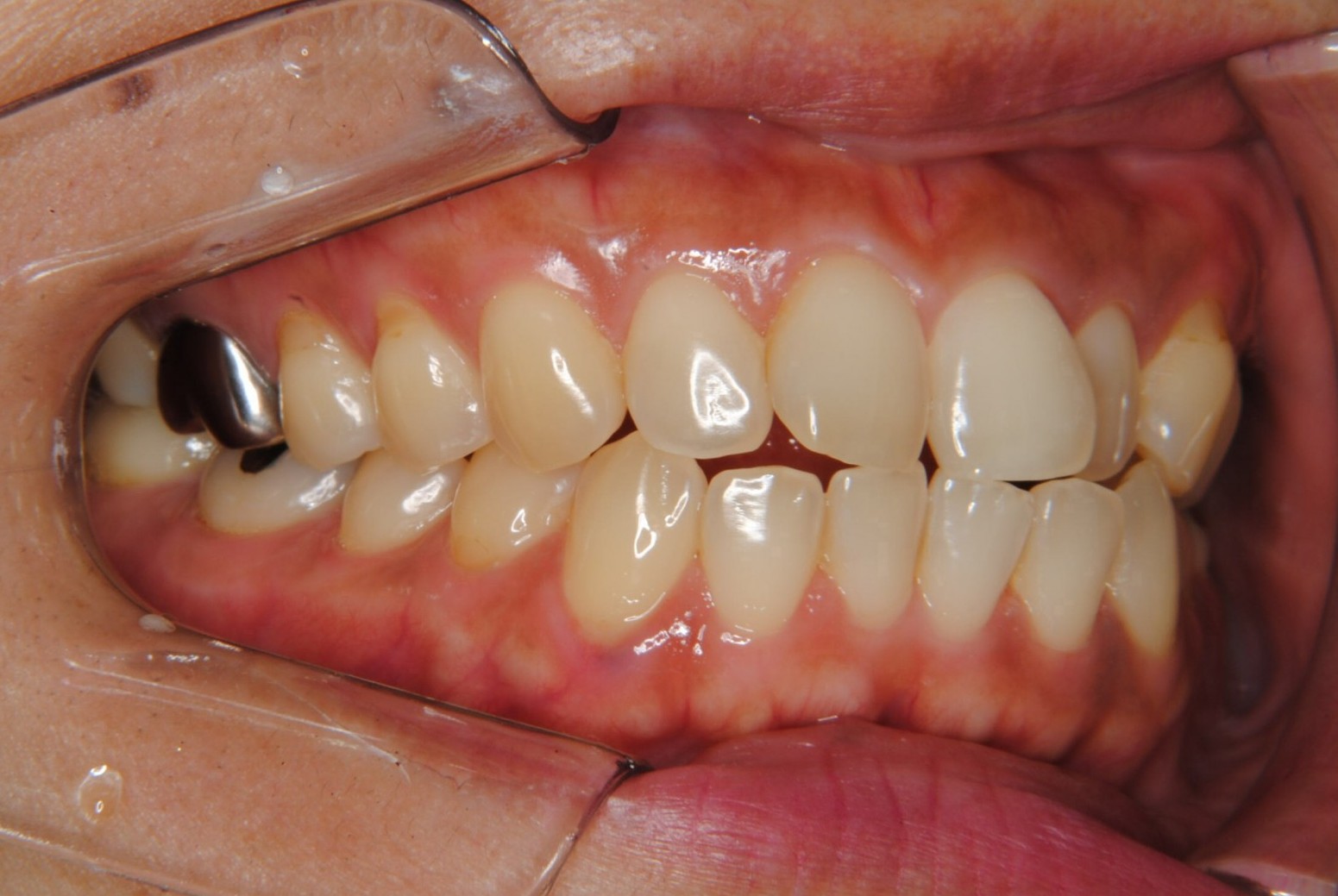 上下前歯の突出を抜歯により治療した40代女性
