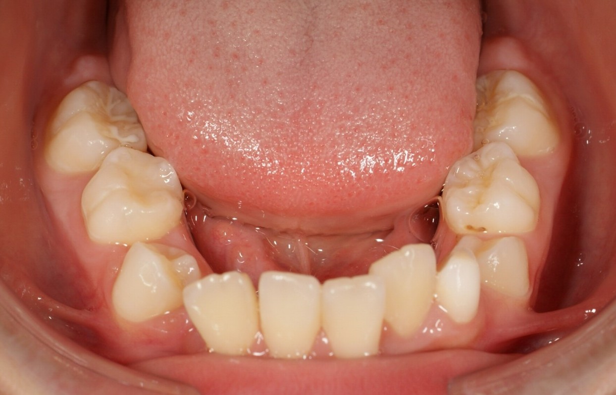 8歳の男子、下左右5番目の乳歯の下の永久歯がなく、上の小臼歯抜歯で治りました。